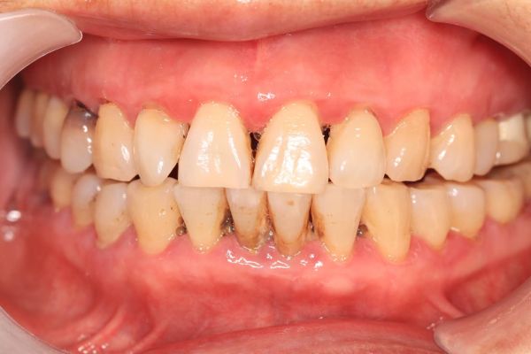 牙周炎修复案例1